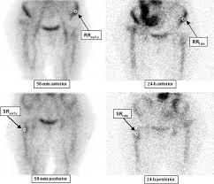 Scintigraphie aux leucocytes marquées | Nucleanord