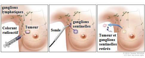 Repérage scintigraphique du ganglion sentinelle | Nucleanord